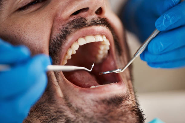 Best Emergency Tooth Extraction in Blackwell, OK