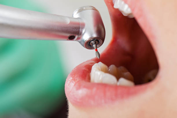 Best Emergency Wisdom Teeth Removal in Blackwell, OK
